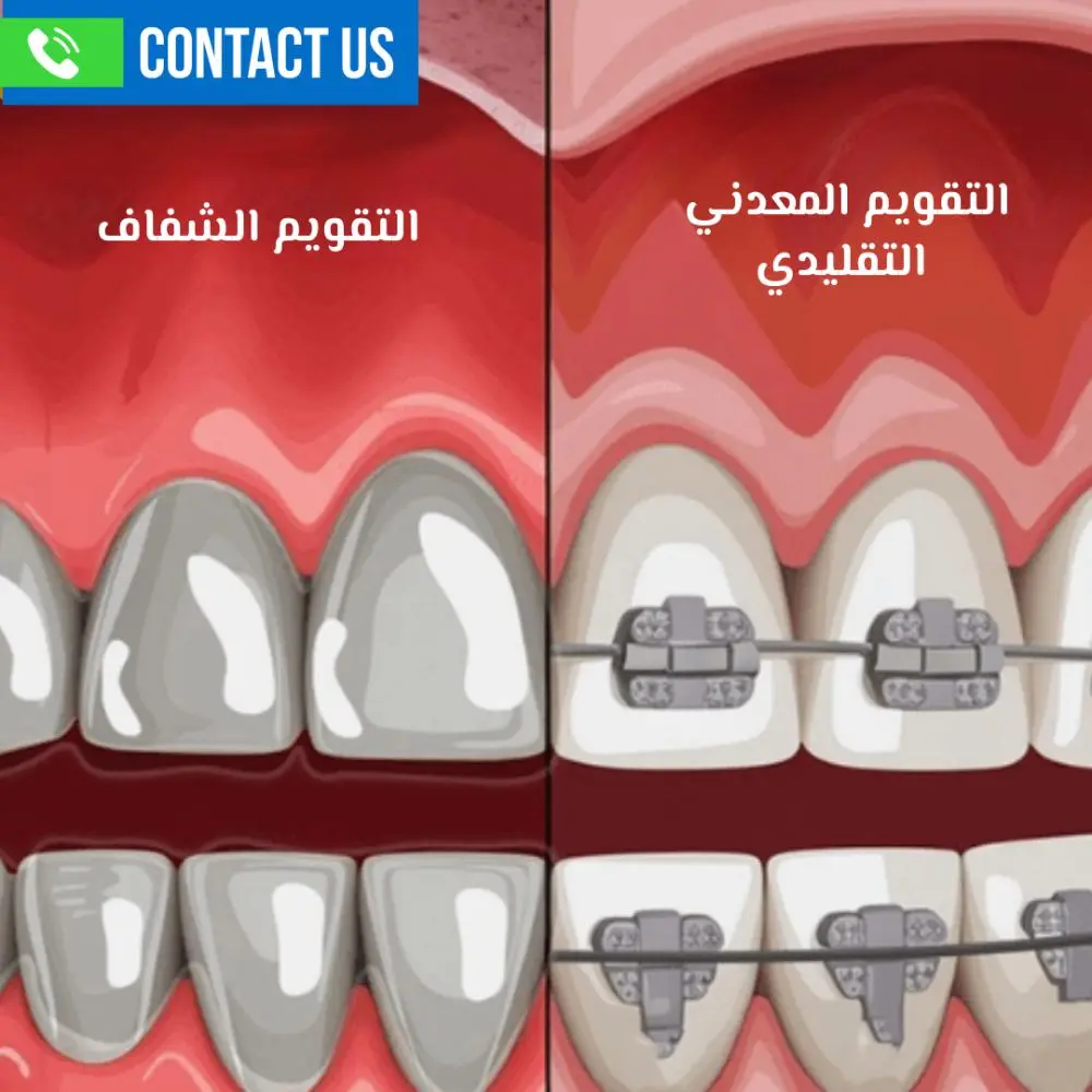 تقويم الأسنان التقليدي مقابل الشفاف